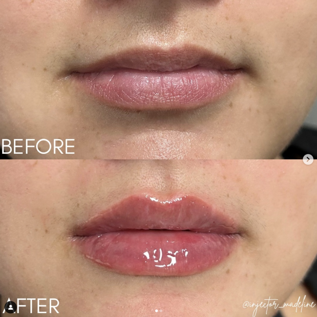 lip filler ashburn va